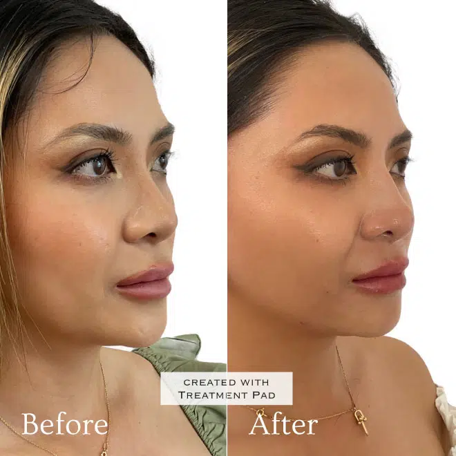 thread lift before after