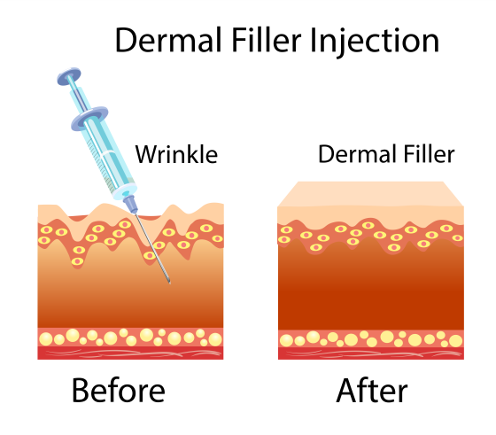 derma fillers before and after